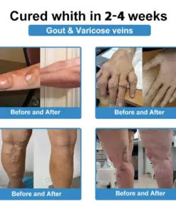 Thonesr® Nano-microneedle joint patch