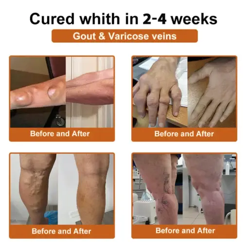 Thonesr® Nano microneedle joint patch