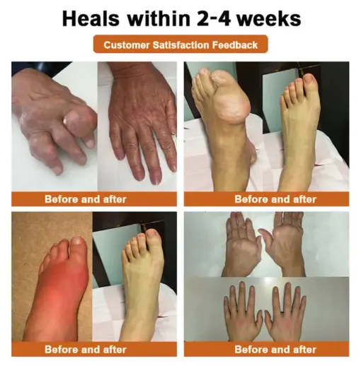 Thonesr® Nano microneedle joint patch