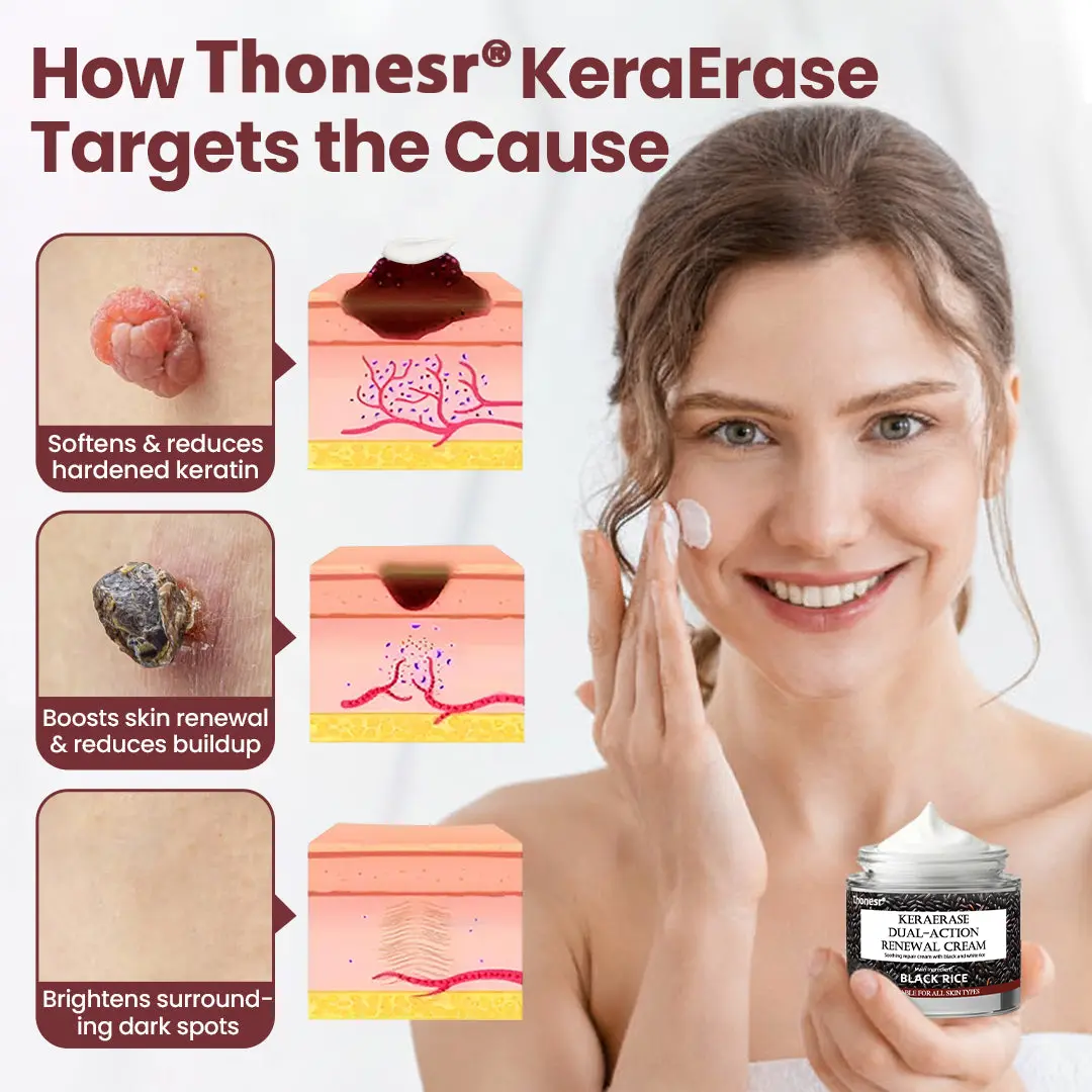 Thonesr® KeraErase Dual-Action Renewal Cream
